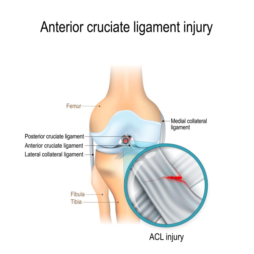 Anterior Cruciate Ligament Injury Site