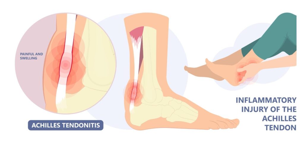 Injury sites during Achilles Tendonitis. Inflammatory Injury of the Achilles' Tendon