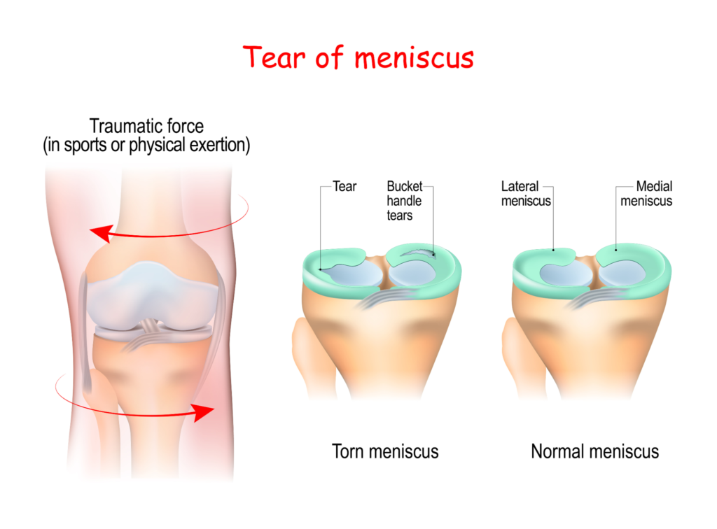 How a tear of meniscus happens