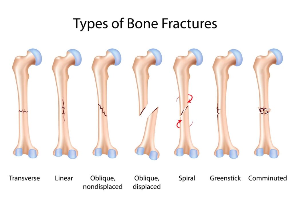 Different types of bone fractures