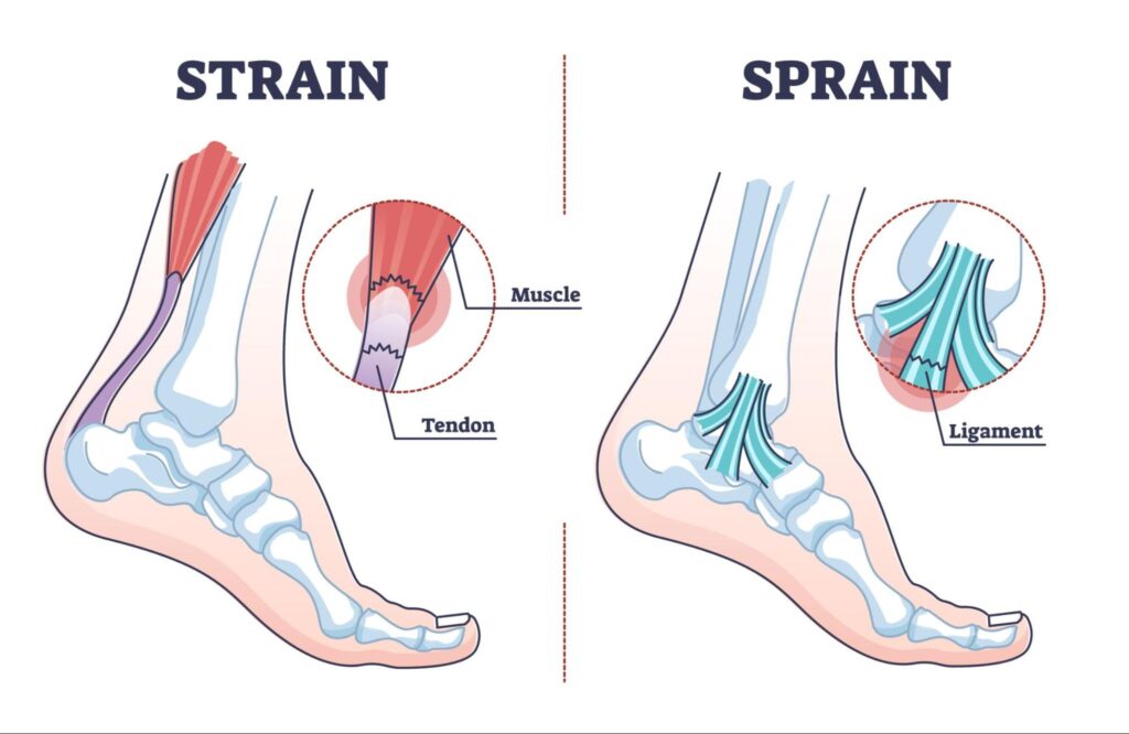 Diagram of the difference between a Sprain and a Strain