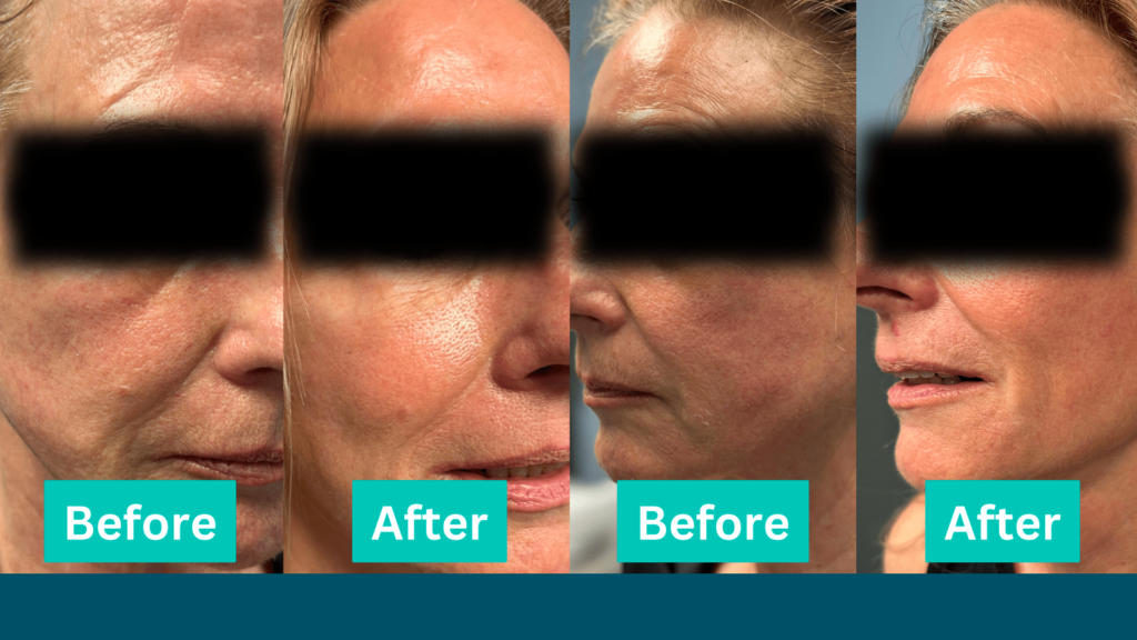 A before and after image of anti-aging treatment